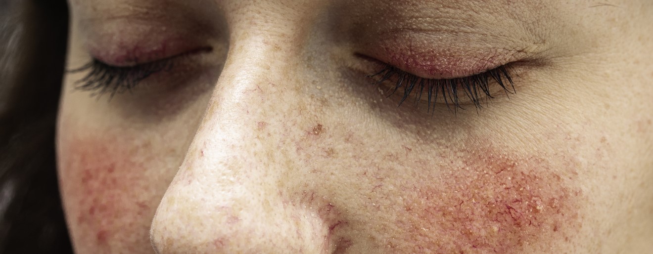 Przyczyny, objawy, pielęgnacja skóry z trądzikiem różowatym